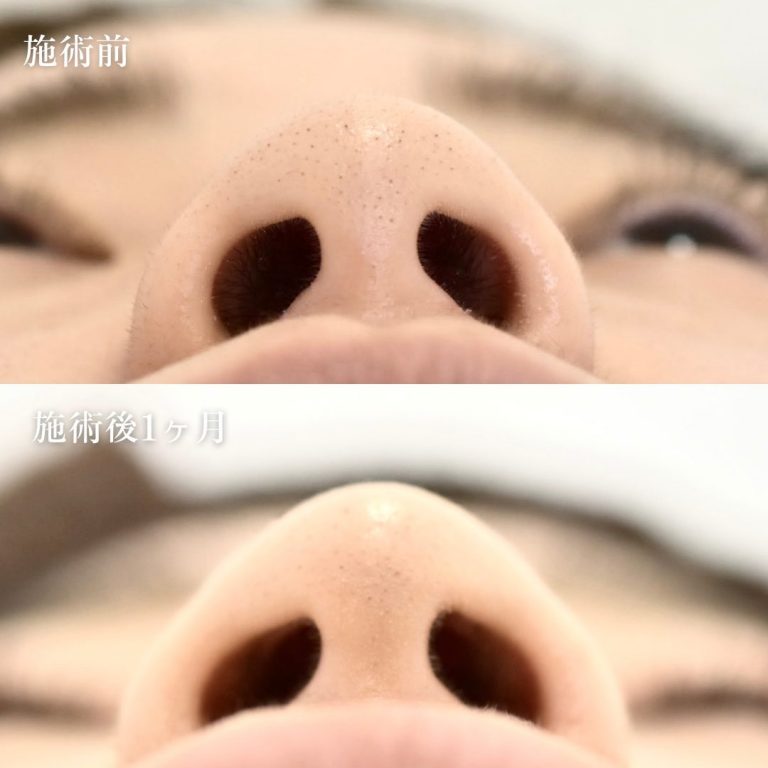 鼻尖形成(担当医:村田 将光 医師)の症例写真1