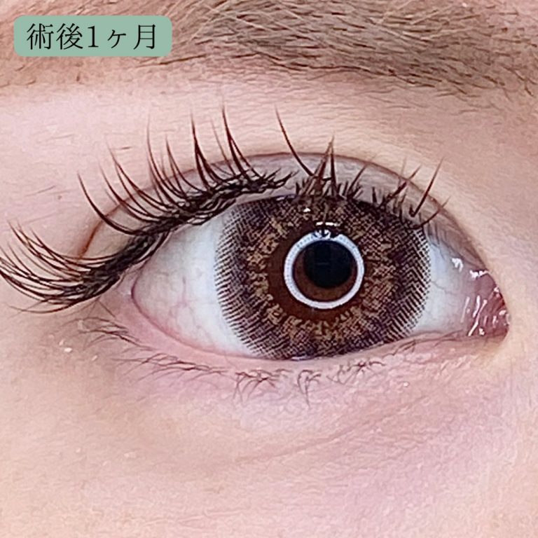 二重埋没法(担当医:宗像 寿祥 医師)の症例写真3