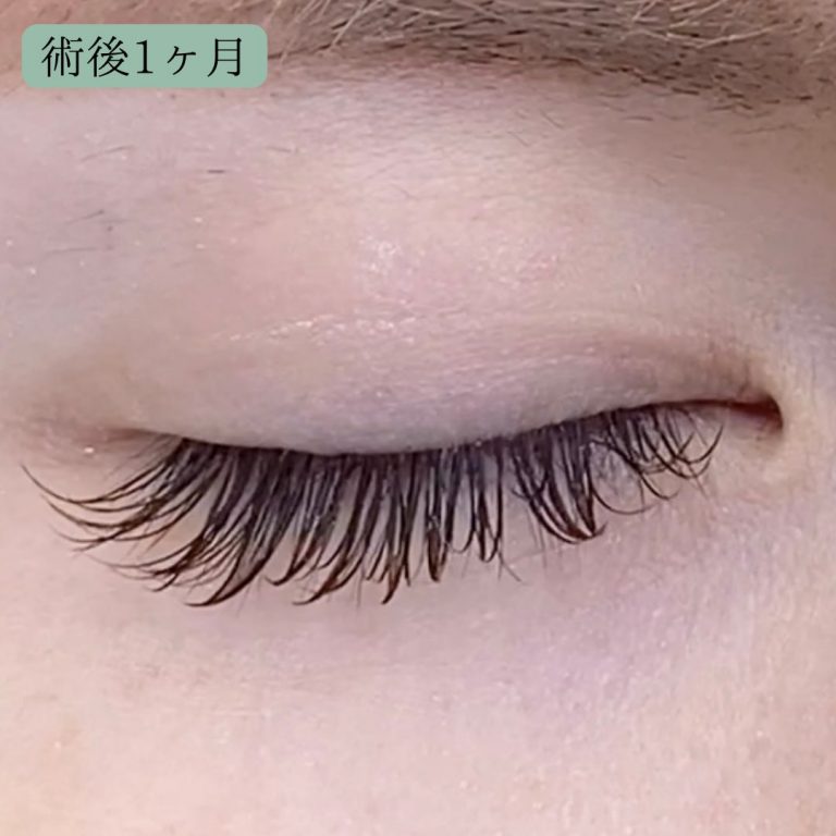 二重埋没法(担当医:宗像 寿祥 医師)の症例写真4