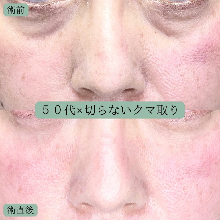 切らない目の下のクマ取り・目の下のたるみ（ふくらみ）取り(担当医:宗像 寿祥 医師)の症例写真1