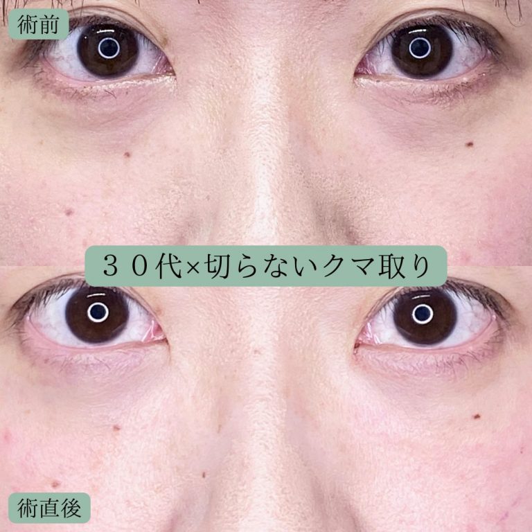 切らない目の下のクマ取り・目の下のたるみ（ふくらみ）取り(担当医:宗像 寿祥 医師)の症例写真1