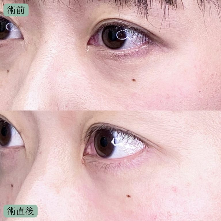 切らない目の下のクマ取り・目の下のたるみ（ふくらみ）取り(担当医:宗像 寿祥 医師)の症例写真2