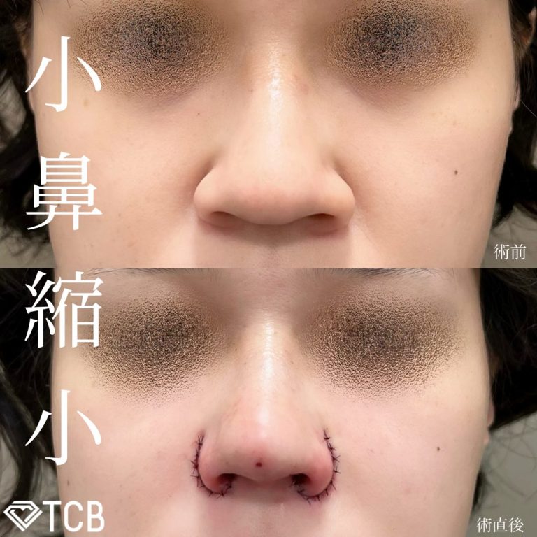 切らない鼻中隔延長(担当医:TCB 医師)の症例写真1