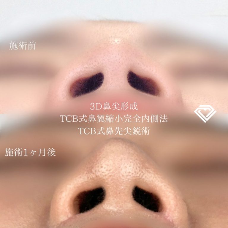 TCB式鼻翼縮小完全内側法・外側法(担当医:TCB 医師)の症例写真1