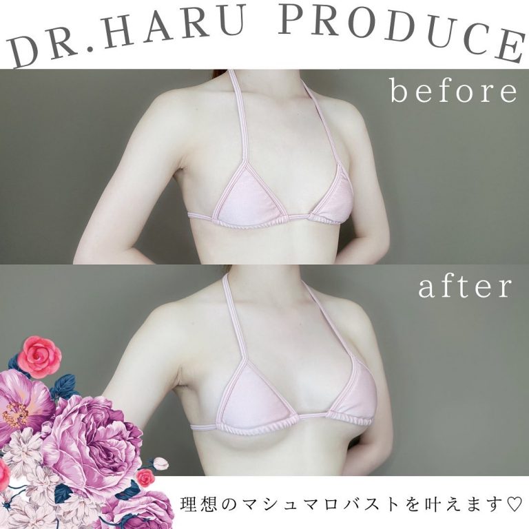 TCB式ヒアルロン酸豊胸(担当医:池田 悠 医師)の症例写真2
