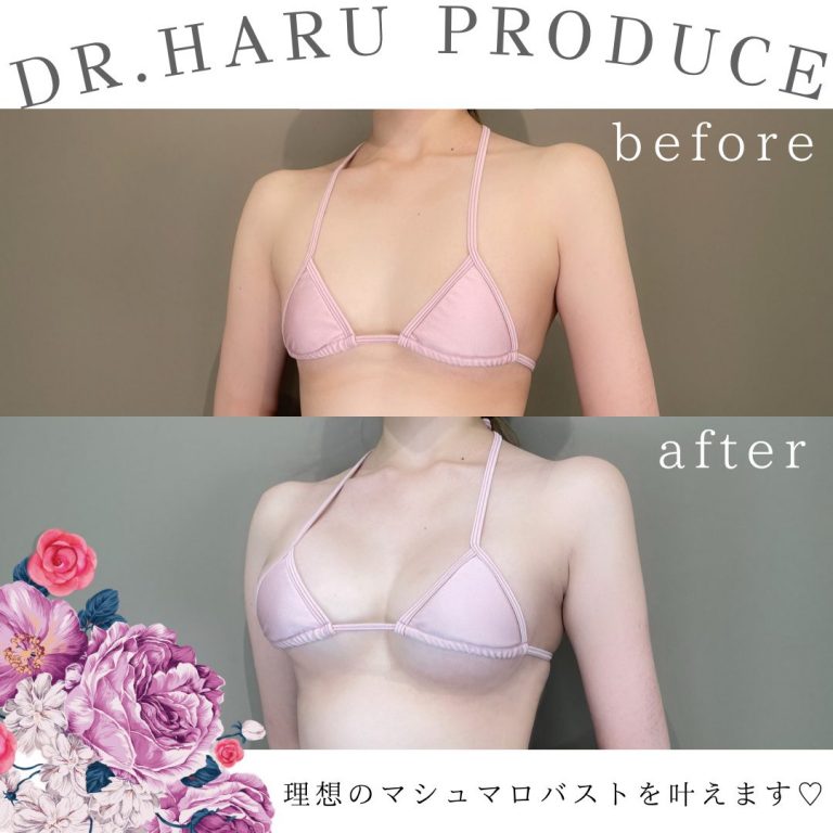 TCB式ヒアルロン酸豊胸(担当医:池田 悠 医師)の症例写真2