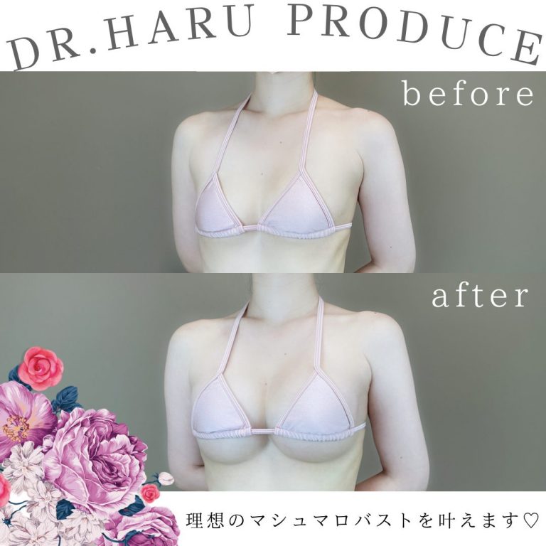 TCB式ヒアルロン酸豊胸(担当医:池田 悠 医師)の症例写真2