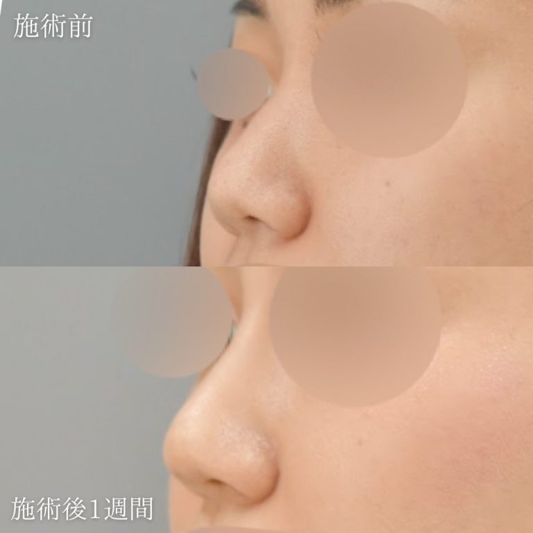 鼻プロテーゼ（隆鼻術）(担当医:村田 将光 医師)の症例写真1