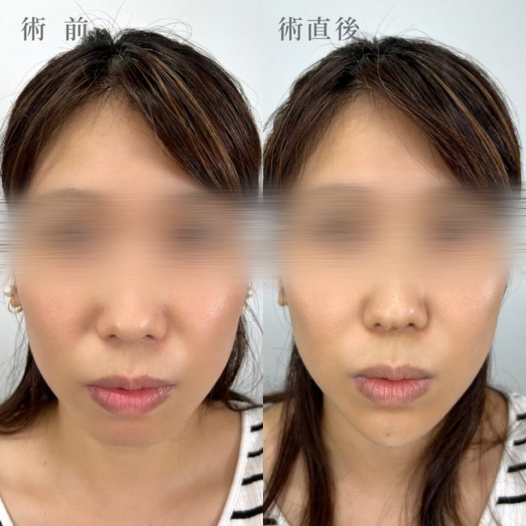 切らない顎形成 3D Eライン(担当医:真鍋 秀明 医師)の症例写真1