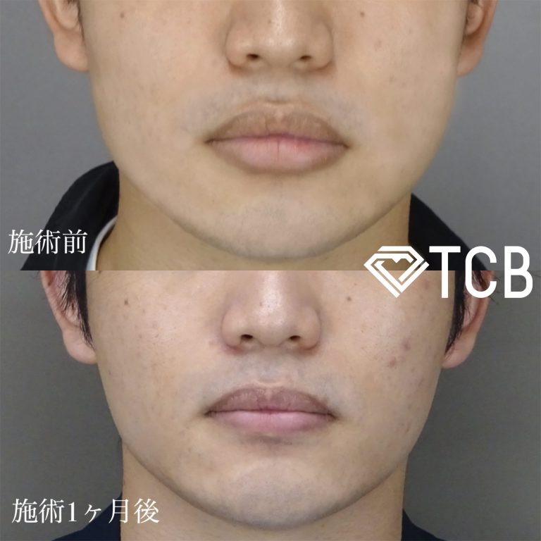 TCB式小顔美肌再生(担当医:佐藤 麻未 医師)の症例写真1
