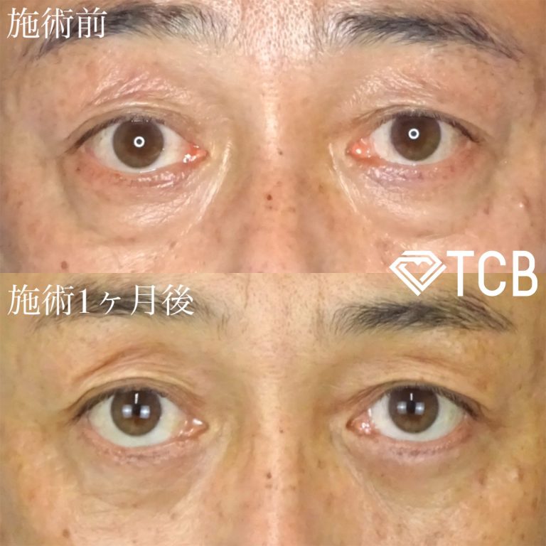 切開法による目の下のたるみ取り（下眼瞼除皺術）(担当医:佐藤 麻未 医師)の症例写真2