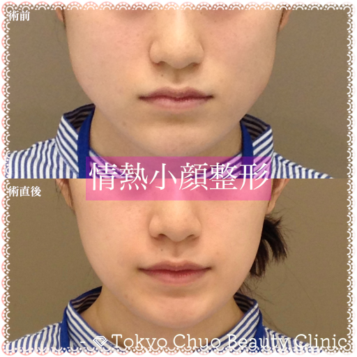 TCB式小顔美肌再生(担当医:奥村 公貴 医師)の症例写真1