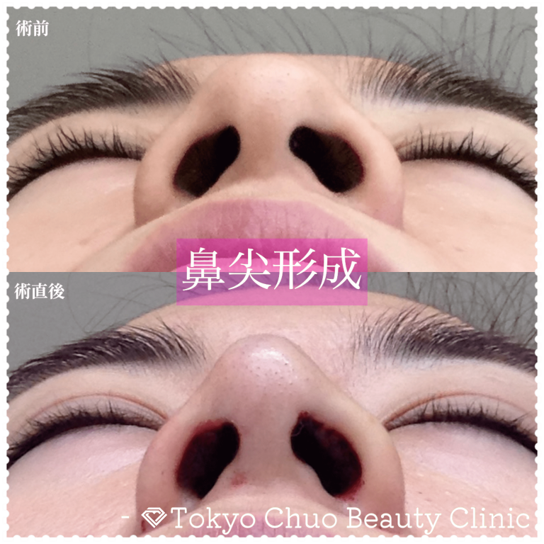 鼻尖形成(担当医:奥村 公貴 医師)の症例写真1