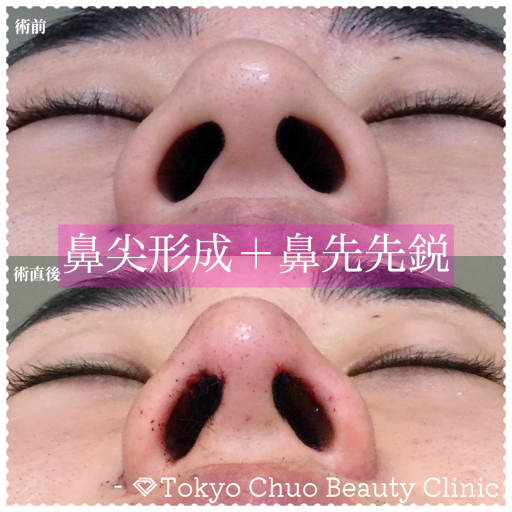 鼻尖形成(担当医:奥村 公貴 医師)の症例写真1