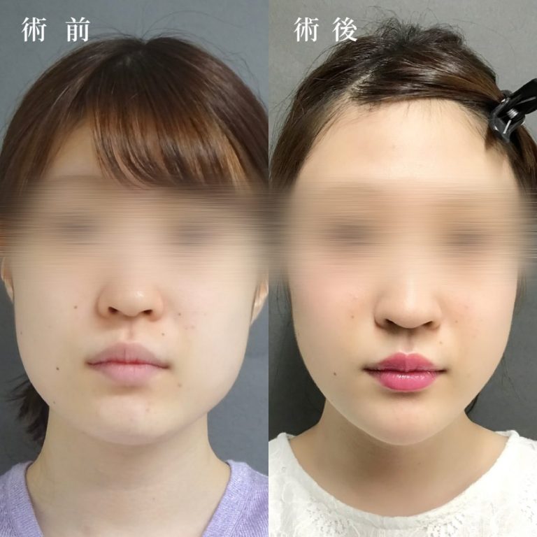 小顔美肌再生（リフトアップ）(担当医:真鍋 秀明 医師)の症例写真1