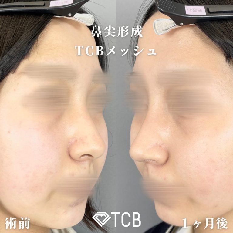 TCBメッシュ(担当医:山内 崇史 医師)の症例写真1