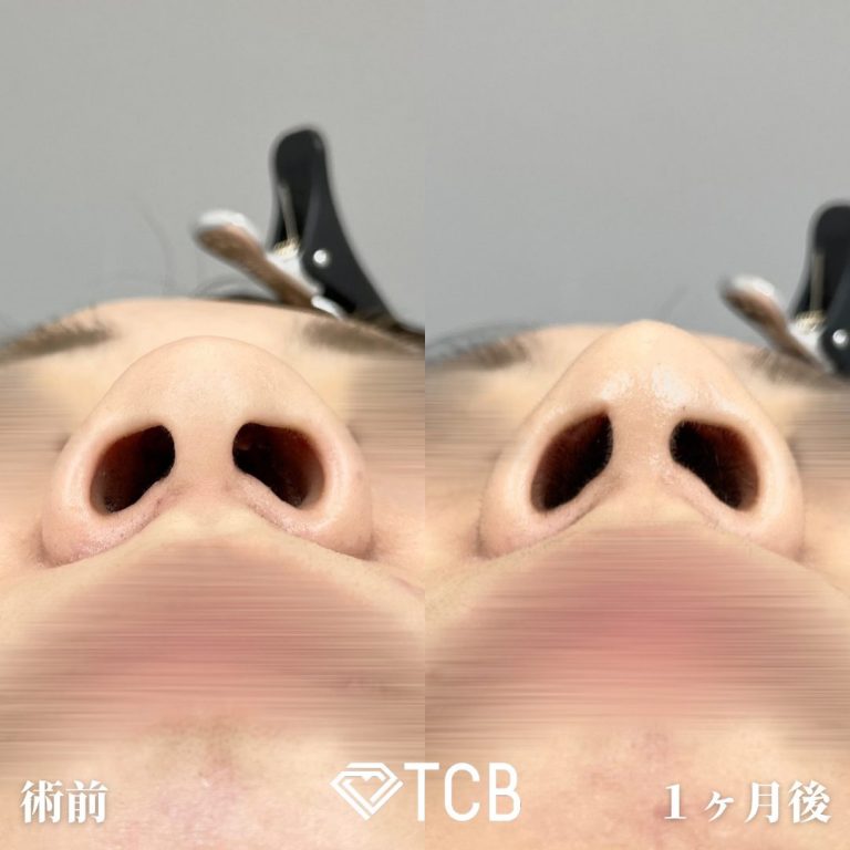 TCBメッシュ(担当医:山内 崇史 医師)の症例写真2