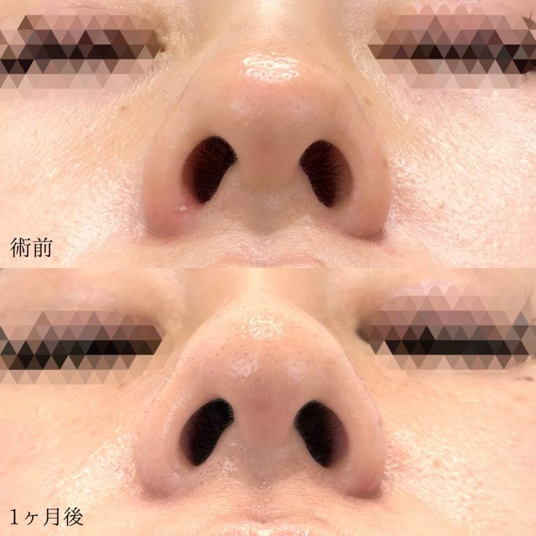 鼻尖形成(担当医:天白 典秀 医師)の症例写真1