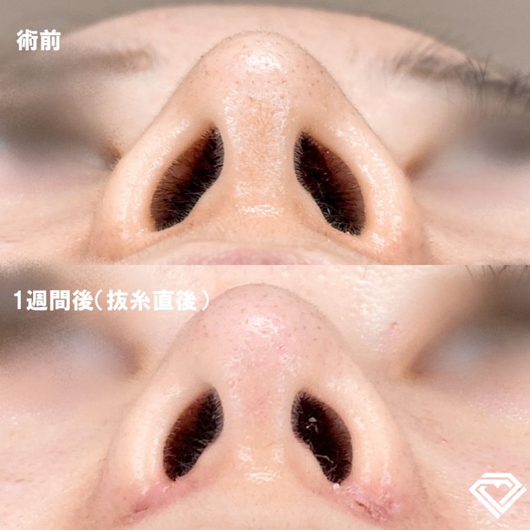 TCB式鼻翼縮小完全内側法(担当医:岡本 卓也 医師)の症例写真1