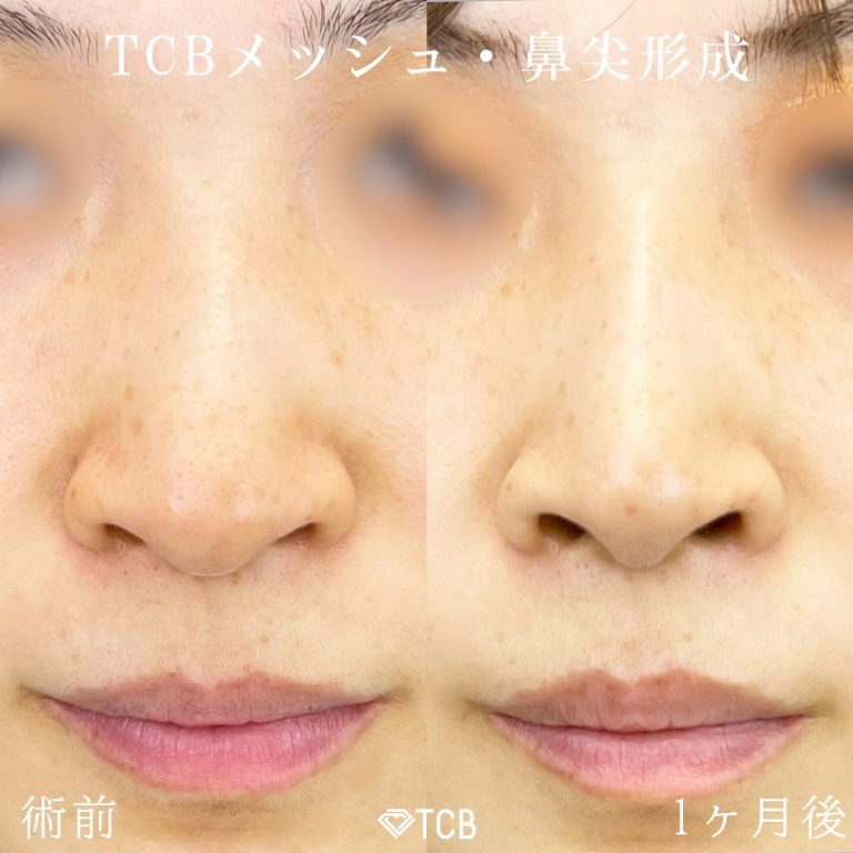TCBメッシュ(担当医:宗 茉裕子 医師)の症例写真1