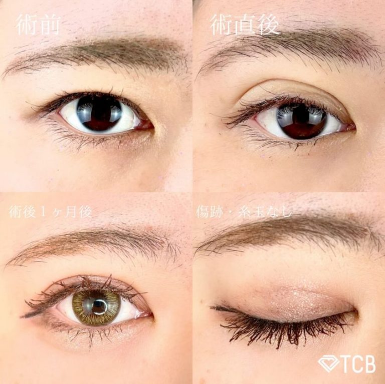 二重埋没法(担当医:TCB 医師)の症例写真1