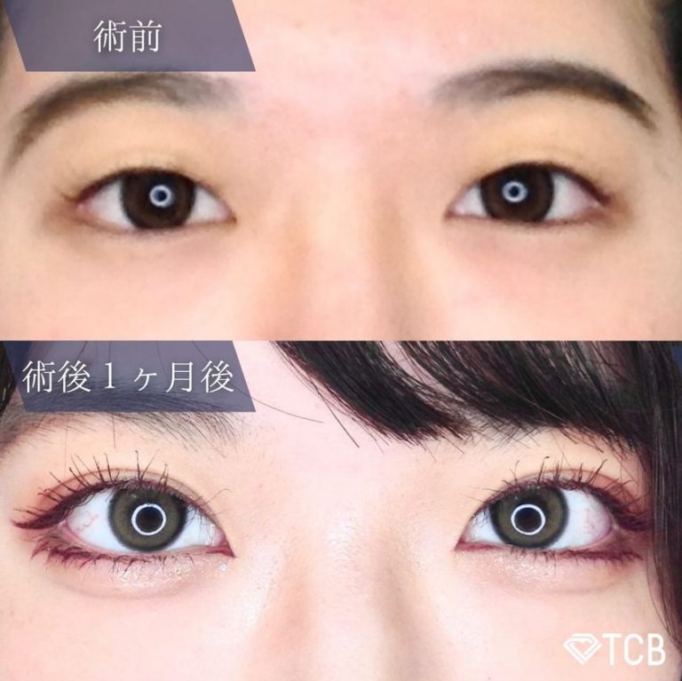 二重埋没法(担当医:TCB 医師)の症例写真1