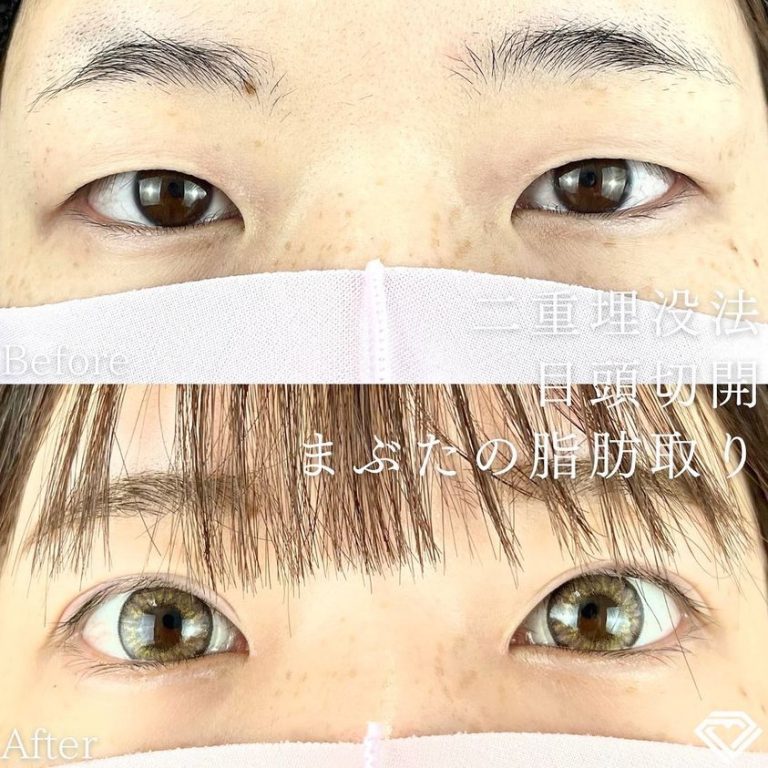 二重埋没法(担当医:TCB 医師)の症例写真1