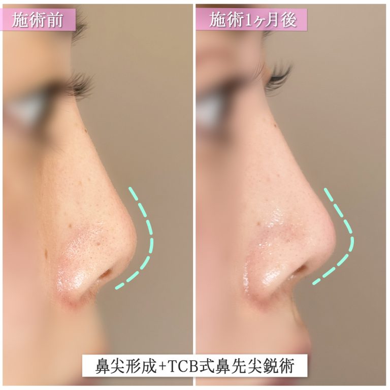 鼻尖形成(担当医:篠永 宏行 医師)の症例写真1