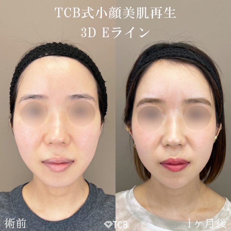 小顔美肌再生（リフトアップ）(担当医:TCB 医師)の症例写真1