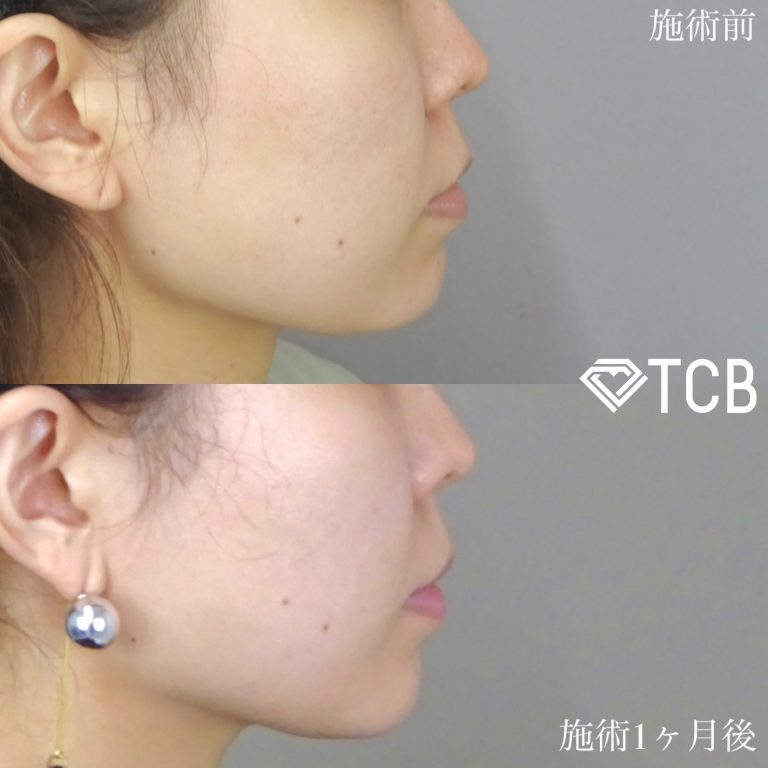 TCB式小顔美肌再生(担当医:TCB 医師)の症例写真2