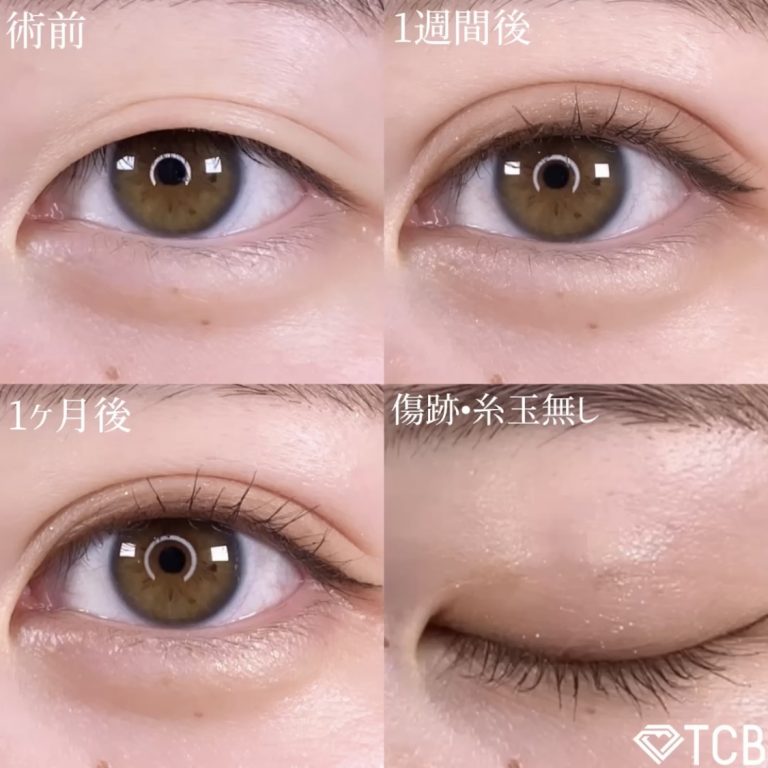 二重埋没法(担当医:TCB 医師)の症例写真1