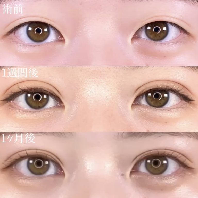 二重埋没法(担当医:TCB 医師)の症例写真2