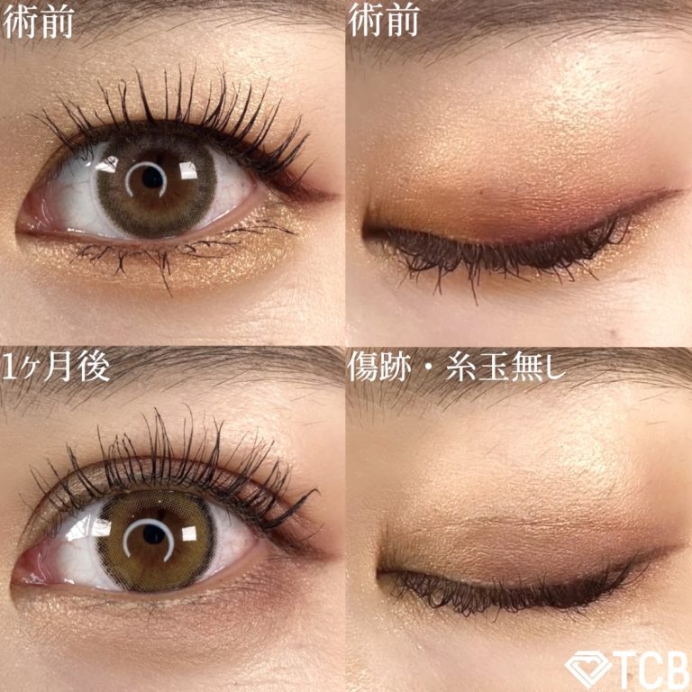 二重埋没法(担当医:TCB 医師)の症例写真1