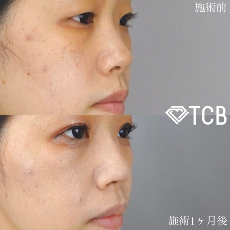 TCB式鼻先尖鋭術（だんご鼻解消）(担当医:佐藤 麻未 医師)の症例写真2