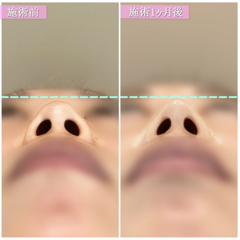鼻尖形成(担当医:篠永 宏行 医師)の症例写真2