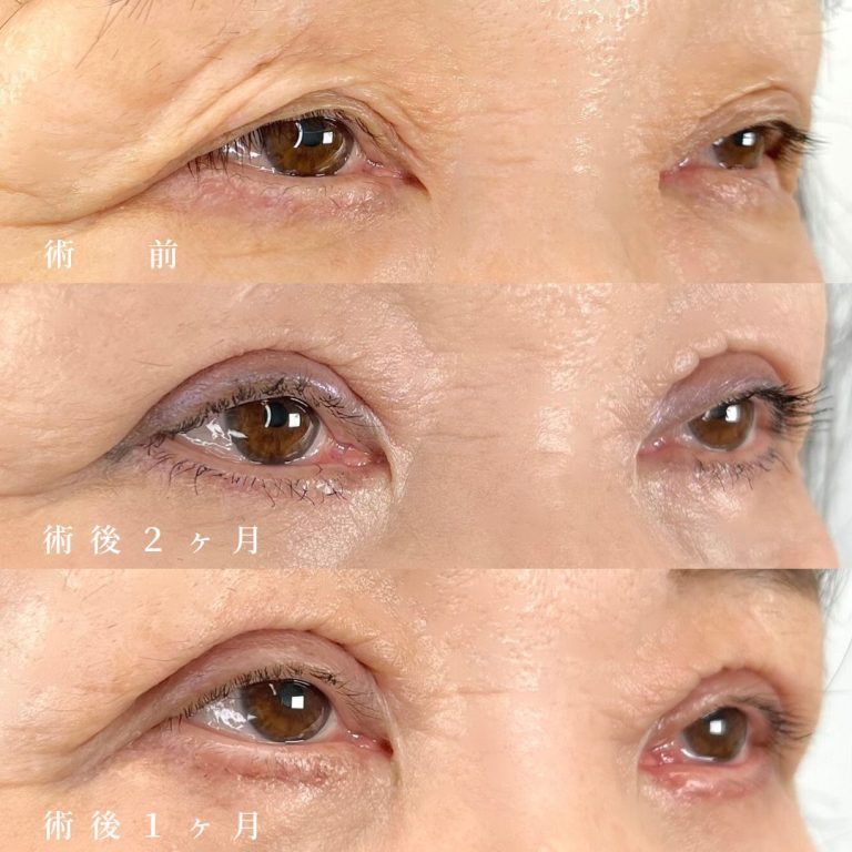 目の上のたるみ取り（上眼瞼除皺術）(担当医:真鍋 秀明 医師)の症例写真2