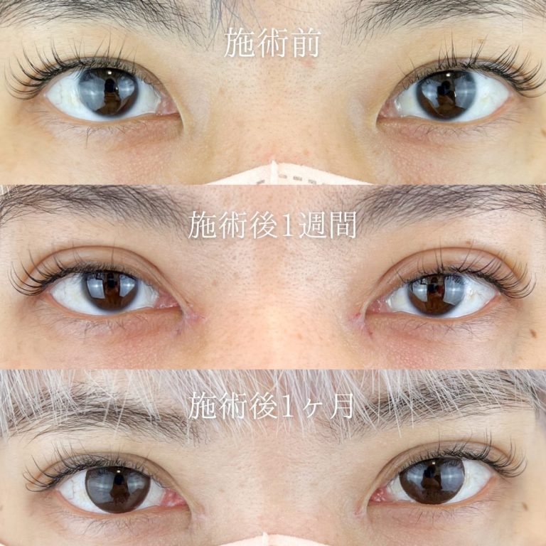 二重埋没法(担当医:林 一樹 医師)の症例写真1