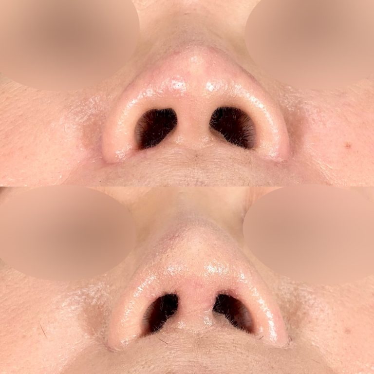 鼻尖形成(担当医:今井 一臣 医師)の症例写真1