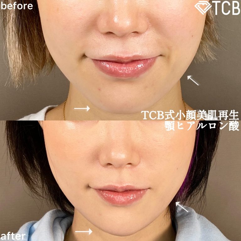 小顔美肌再生（リフトアップ）(担当医:TCB 医師)の症例写真1