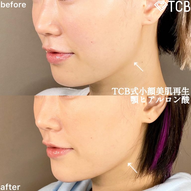 小顔美肌再生（リフトアップ）(担当医:TCB 医師)の症例写真2