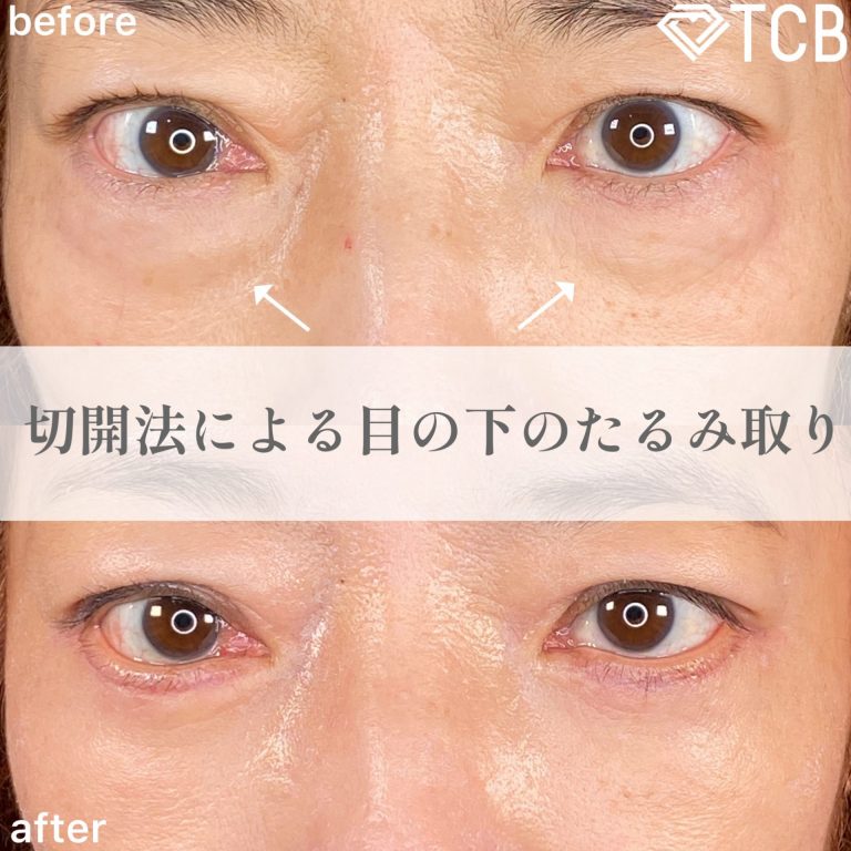 切開法による目の下のたるみ取り（下眼瞼除皺術）(担当医:森本 理一郎 医師)の症例写真1