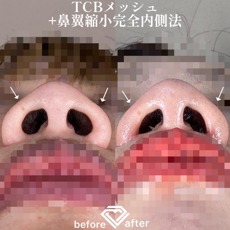 TCB式鼻翼縮小完全内側法(担当医:森本 理一郎 医師)の症例写真4