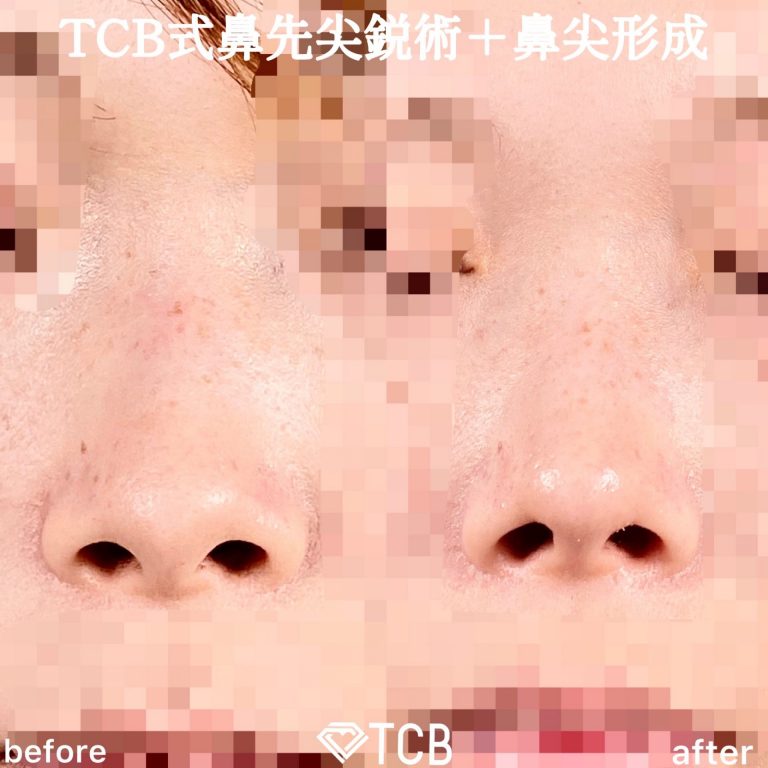 TCB式鼻先尖鋭術（だんご鼻解消）(担当医:TCB 医師)の症例写真2