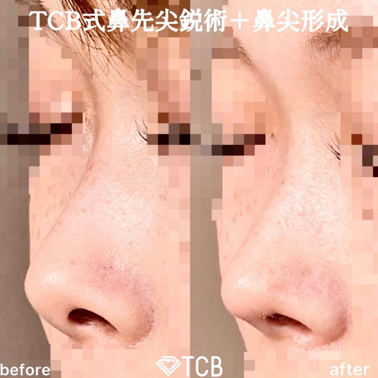 TCB式鼻先尖鋭術（だんご鼻解消）(担当医:TCB 医師)の症例写真3