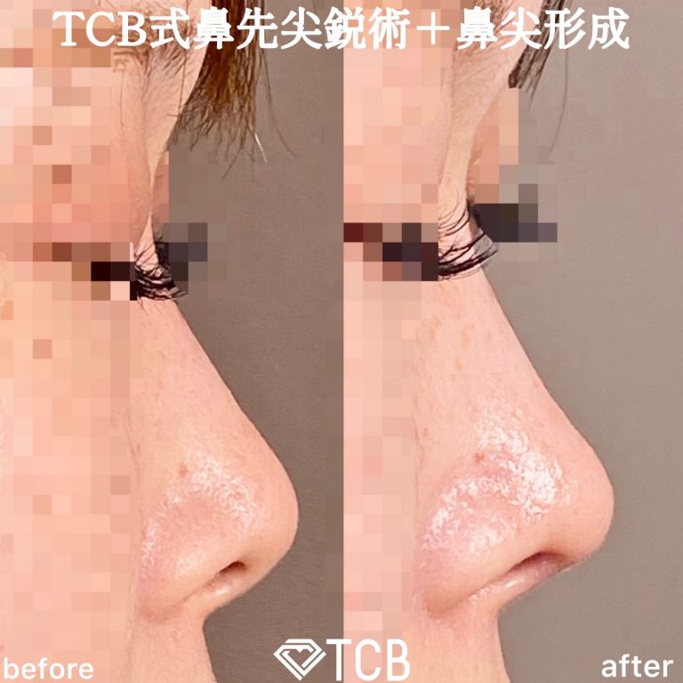 TCB式鼻先尖鋭術（だんご鼻解消）(担当医:TCB 医師)の症例写真1