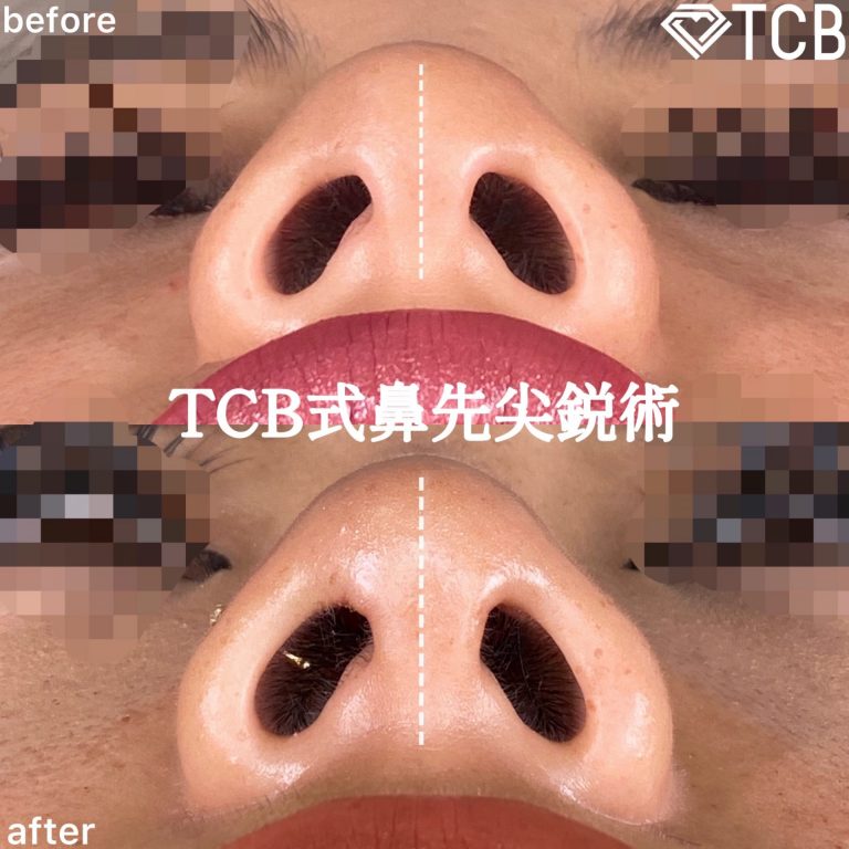 TCB式鼻先尖鋭術（だんご鼻解消）(担当医:TCB 医師)の症例写真1