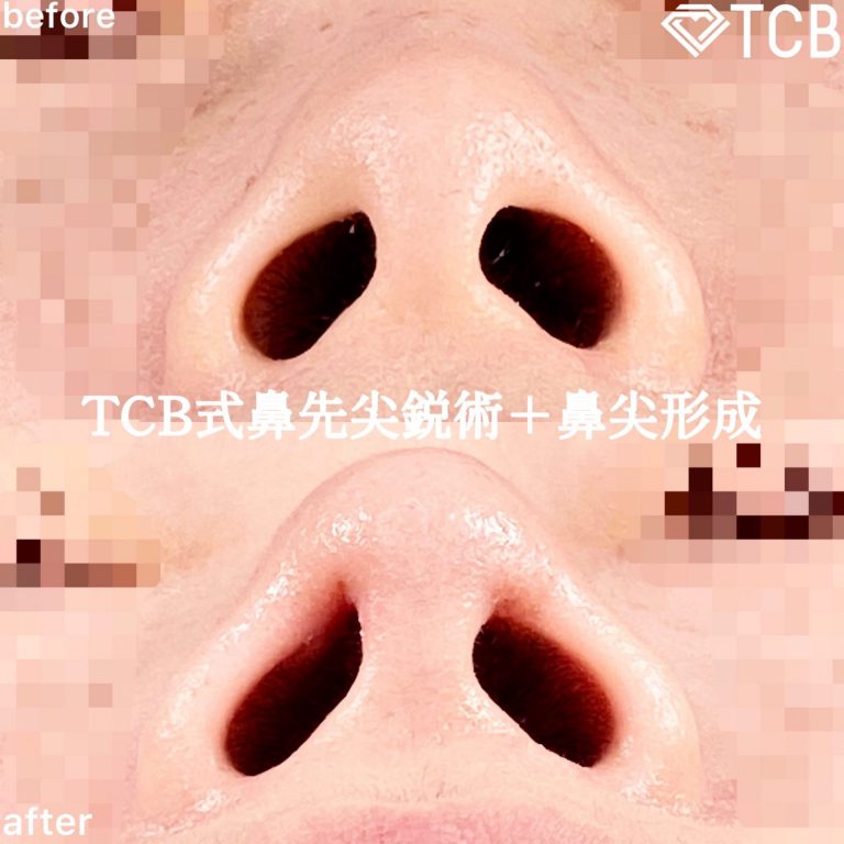 TCB式鼻先尖鋭術（だんご鼻解消）(担当医:TCB 医師)の症例写真4