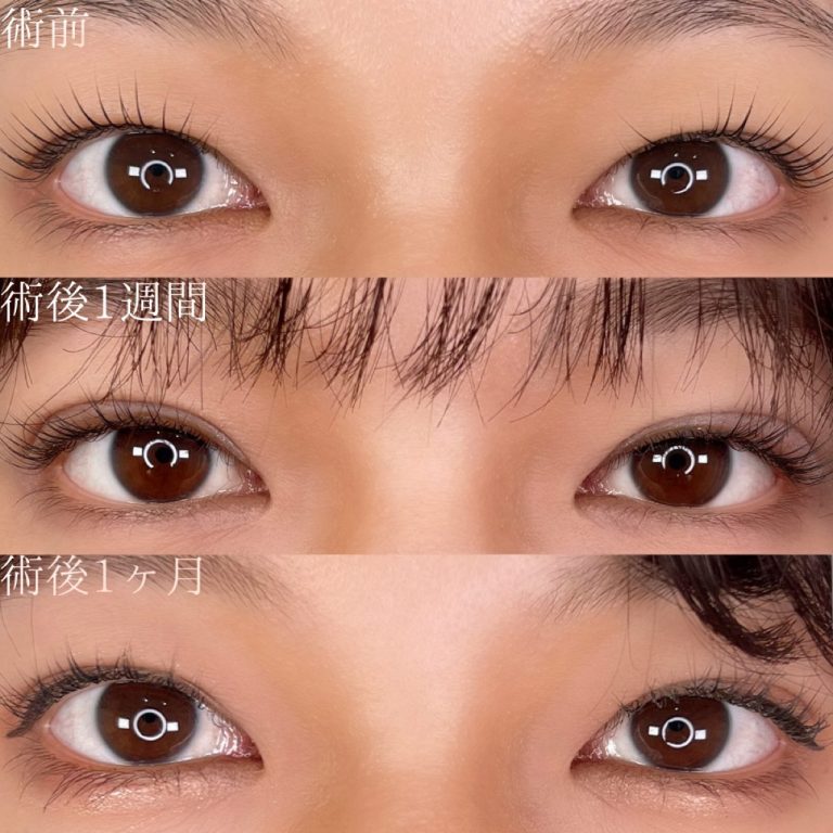 二重埋没法(担当医:TCB 医師)の症例写真1