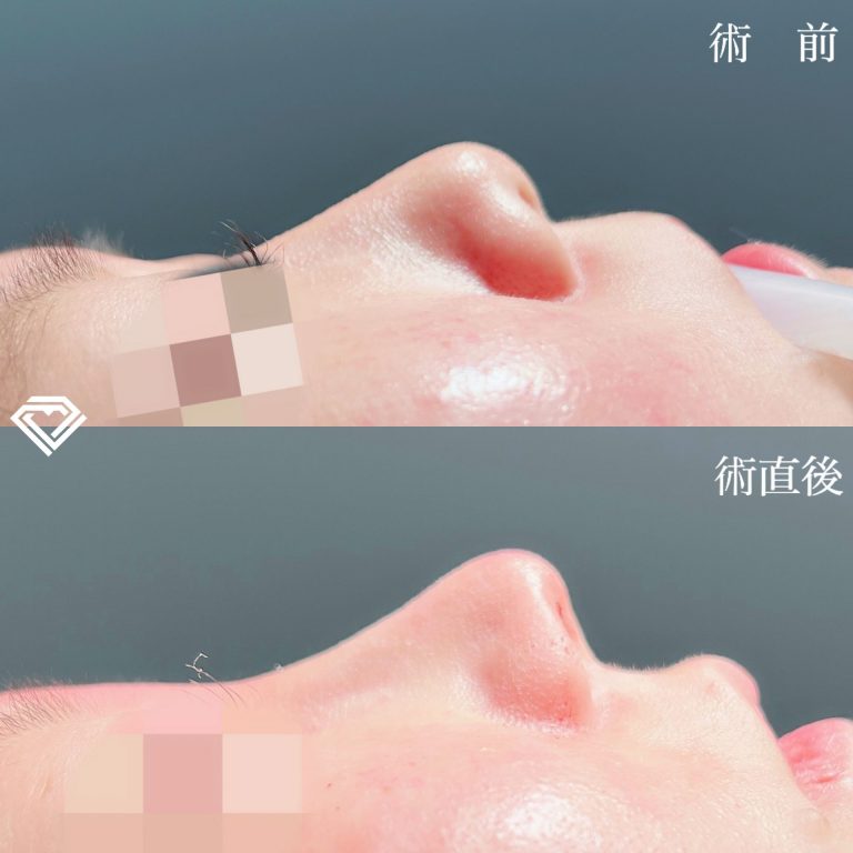 鼻尖形成(担当医:TCB 医師)の症例写真1