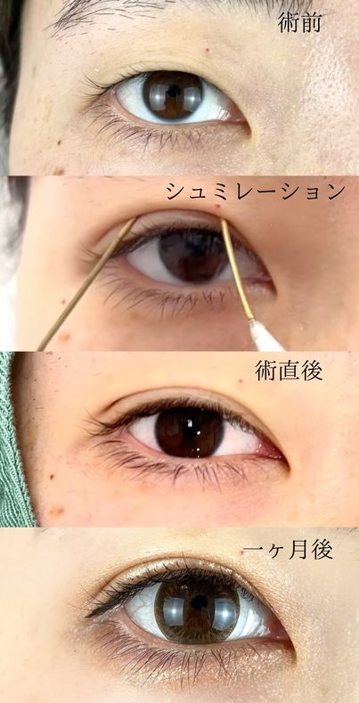 二重埋没法(担当医:TCB 医師)の症例写真1